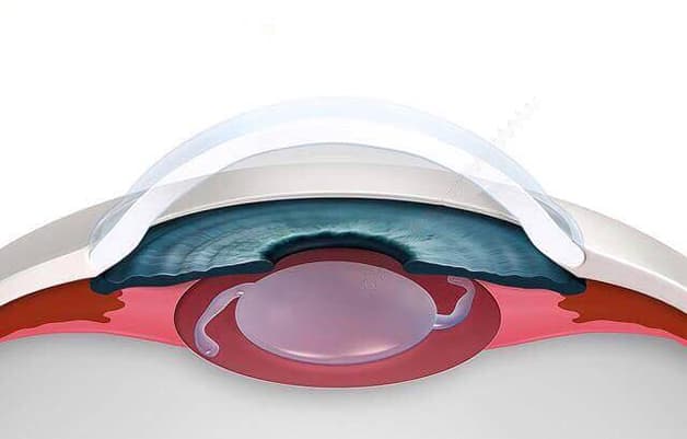 Thủy tinh thể nhân tạo