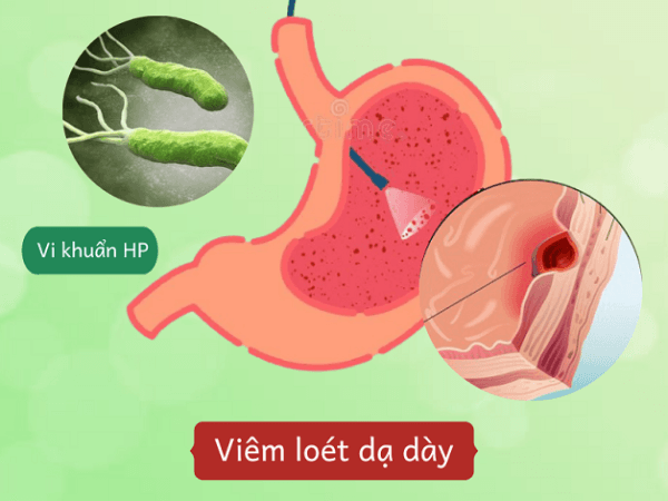 Vi khuẩn HP gây viêm loét dạ dày