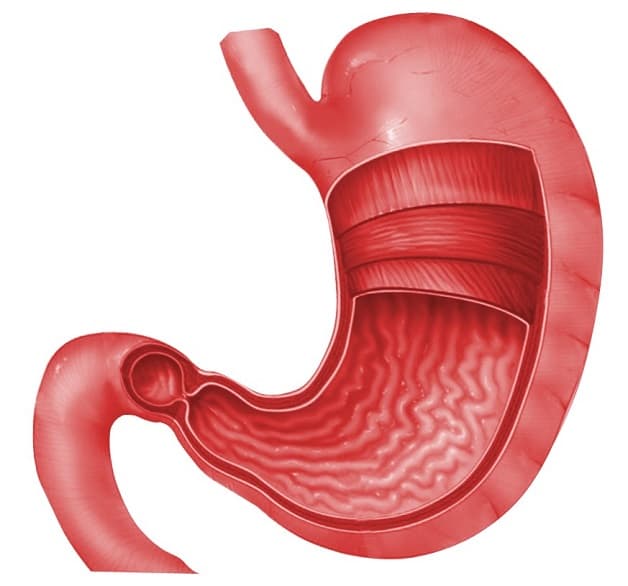 Viêm niêm mạc dạ dày là khi dạ dày xuất hiện các vết loét