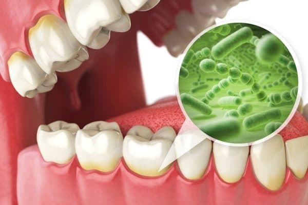 Nhiễm khuẩn, sang chấn là những nguyên nhân chính gây nên tình trạng răng bị viêm quanh cuống