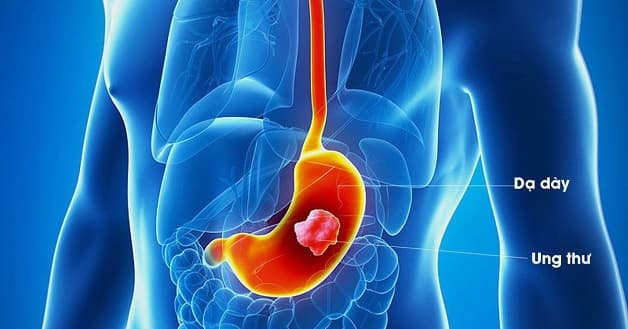 Viêm hang vị có thể chữa bởi nhiều phương pháp khác nhau