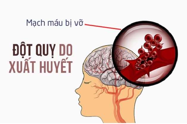 Vỡ mạch máu não là gì?