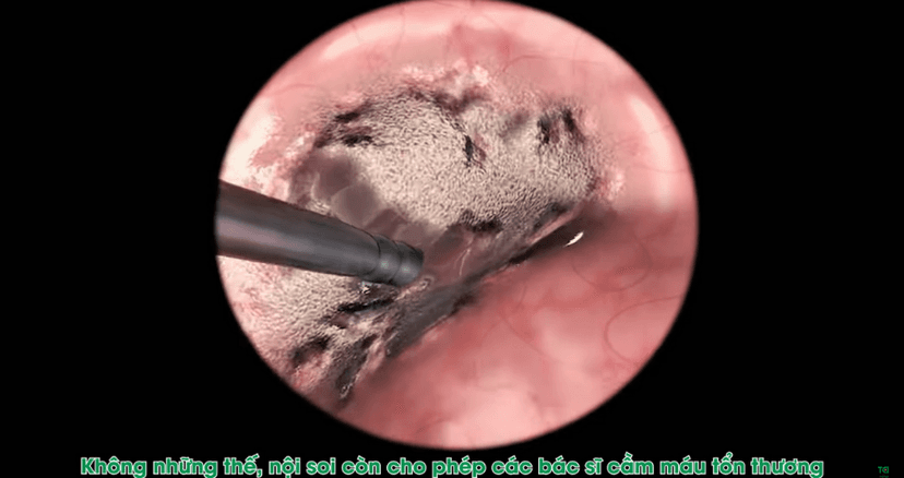 Nội soi dạ dày – đại tràng: “Tiêu chuẩn vàng” kiểm soát sức khỏe đường tiêu hóa