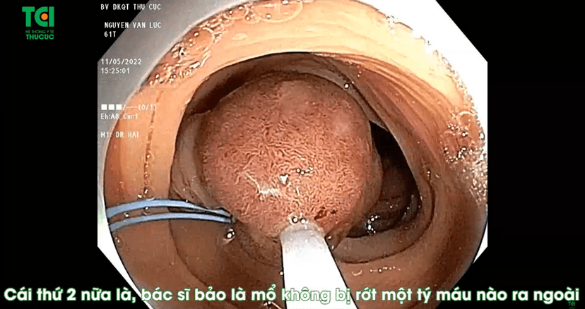 Loại bỏ 9 polyp lớn tại đại tràng chỉ trong 1 ngày
