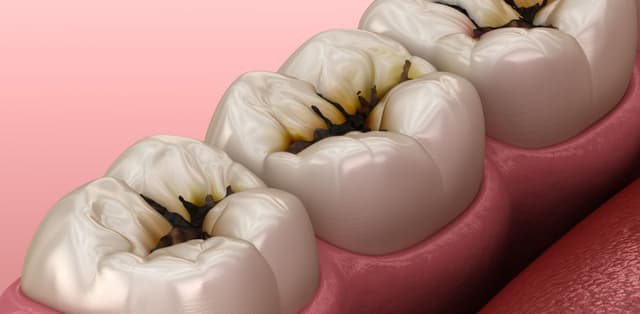 Cách ngừa sâu răng cho người lớn hiệu quả, dễ áp dụng