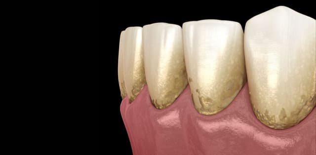 Cao răng hình thành như thế nào, có hại không?