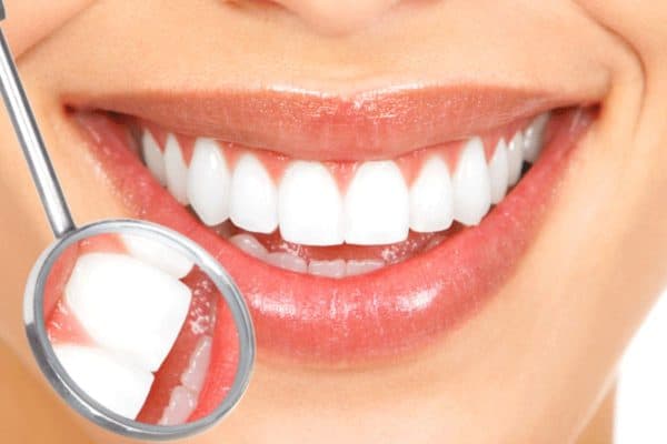 Tuổi thọ của dán sứ veneer được bao lâu còn tuỳ thuộc vào rất nhiều yếu tố