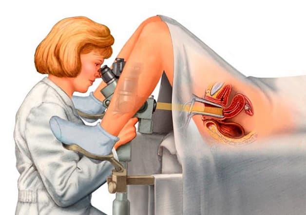 khi nào nên soi cổ tử cung