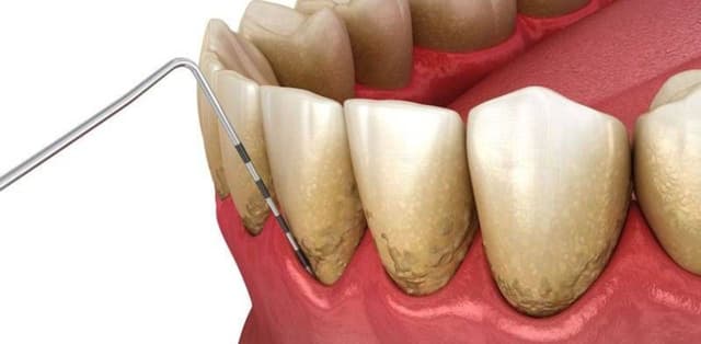 Lấy cao răng có tác dụng gì đối với răng miệng?