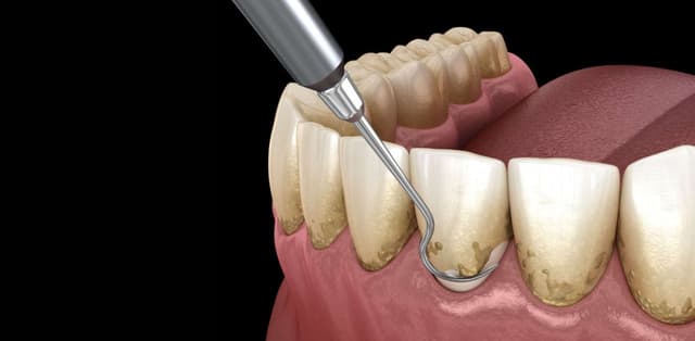 Tìm hiểu: Lấy cao răng nhiều có tốt không?
