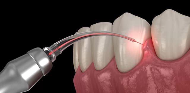 Phẫu thuật hở lợi: Phương pháp thực hiện, chi phí điều trị
