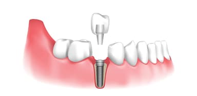 Tìm hiểu về kỹ thuật phục hình răng sứ trên Implant