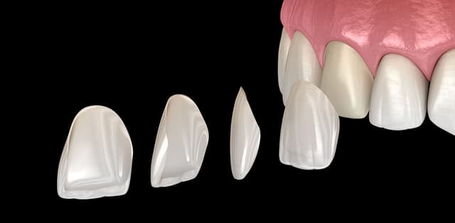 Tìm hiểu về quy trình dán sứ veneer tại nha khoa