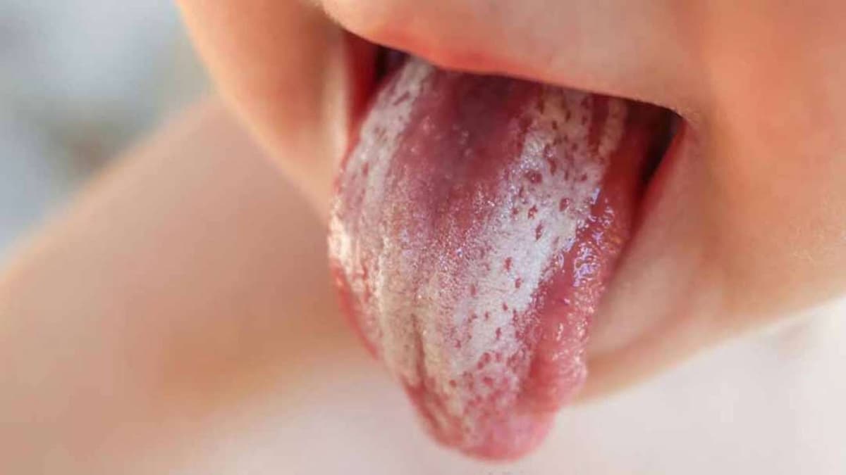 Tìm hiểu nguyên nhân tại sao bị nấm miệng 