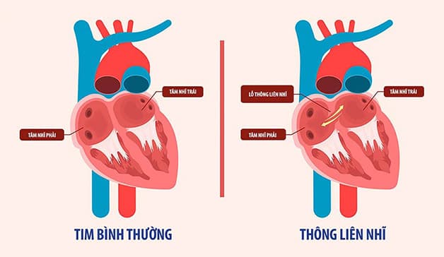 Thông liên nhĩ là bệnh lý về tim gây khó khăn, nguy hiểm cho các mẹ bầu trong quá trình vượt cạn