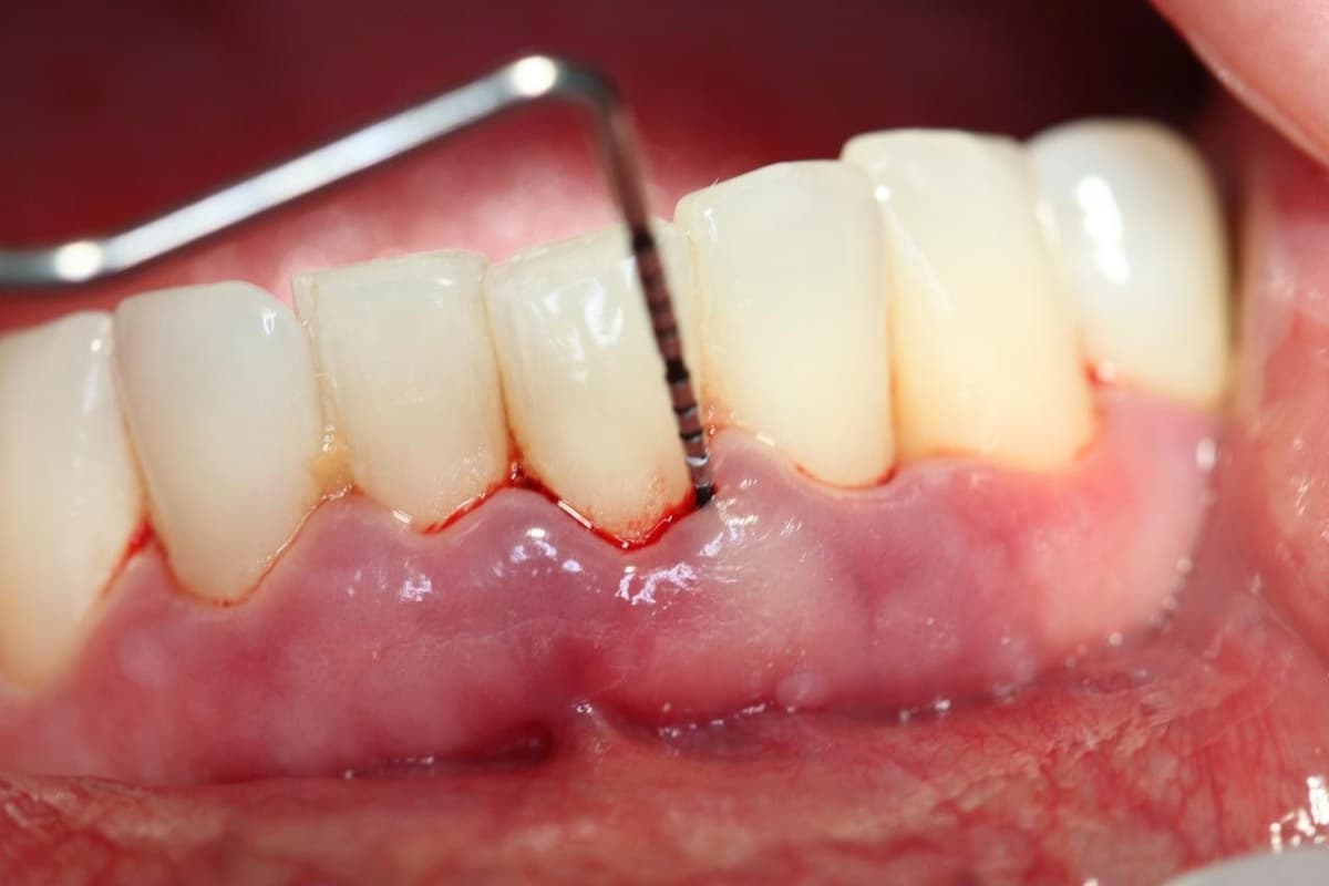 Điểm danh các triệu chứng viêm nha chu thường gặp nhất