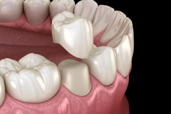 Bọc răng sứ là kỹ thuật phục hình răng bằng cách mài răng thật và dán mão sứ bên ngoài