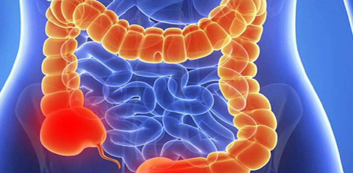 Viêm manh tràng và những điều cần biết