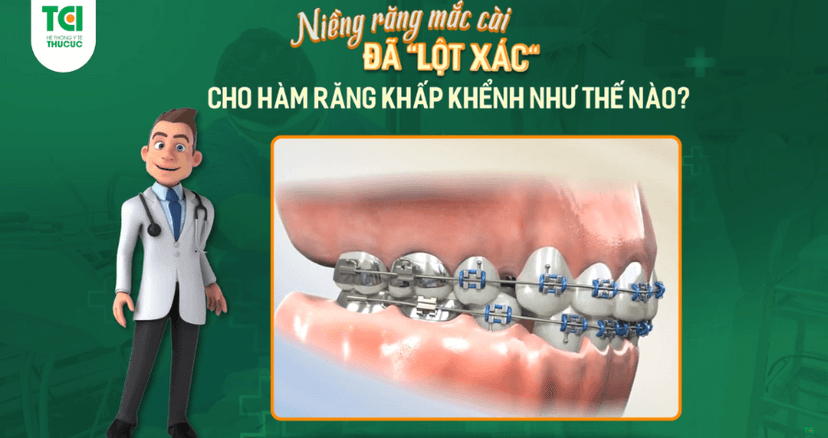 Niềng Răng Mắc Cài đã lột xác cho hàm răng khấp khểnh như thế nào?