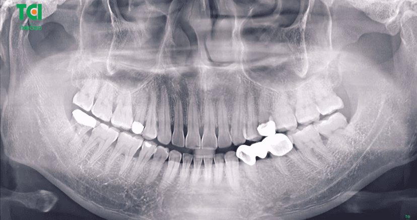 Điều trị tủy, làm trục sứ cho khách hàng bị sâu răng hỏng tủy