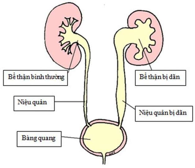 Điều trị hẹp niệu đạo giảm tối đa nguy cơ biến chứng