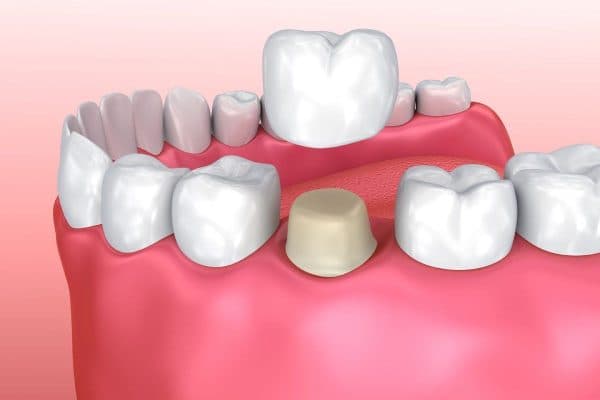 Với phương pháp bọc răng sứ, răng thật được mài để tạo trụ đỡ mão sứ phía trên