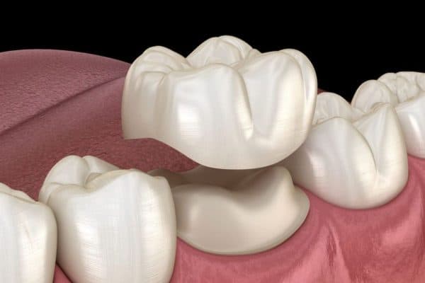 Bọc răng sứ là kỹ thuật gắn mão sứ lên trên cùi răng thật sau khi mài để phục hình 