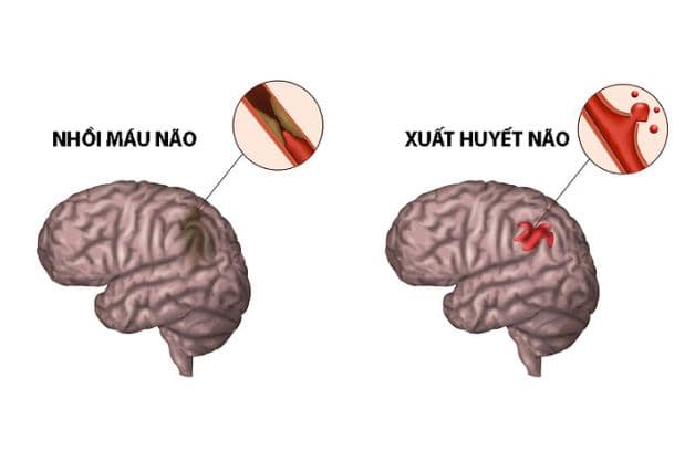 Phân loại tai biến mạch máu não ở người bệnh