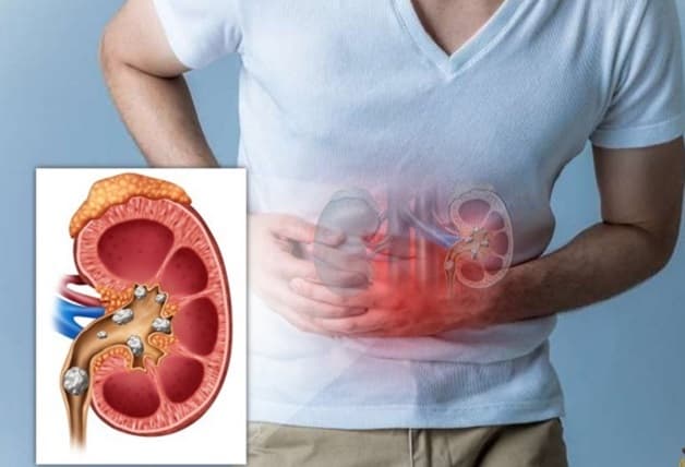 phương pháp tán sỏi ngoài cơ thể