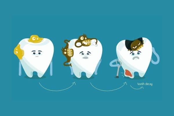 Nguyên nhân chính gây ra tình trạng răng sâu là do một số vi khuẩn tạo axit làm tổn thương men răng