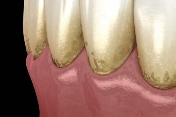 Cao răng là các mảng bám bị vôi hóa bởi các hợp chất muối calcium phosphate có trong nước bọt