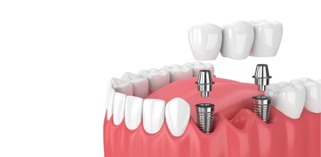 Giải đáp: Kỹ thuật cấy ghép Implant có nguy hiểm không?