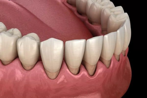 Khi bị viêm lợi, mọi người thường gặp phải tình trạng sưng tấy, tụt nướu, chảy máu nướu...