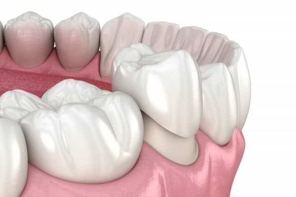 Răng thật đưRăng thật được mài để tạo không gian cho mão sứ, giúp hàm răng sau khi phục hình trở nên chắc và thẩm mỹợc mài với kích thước phù hợp để tạo không gian cho mão sứ, giúp hàm răng sau khi phục hình trở nên chắc và thẩm mỹ