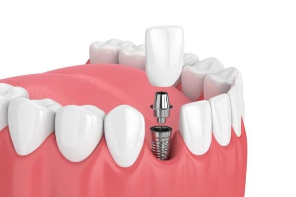 Phương pháp trồng răng Implant sử dụng kết cấu răng bao gồm 3 phần cơ bản là: Trụ Implant, mão răng sứ và khớp nối Abutment