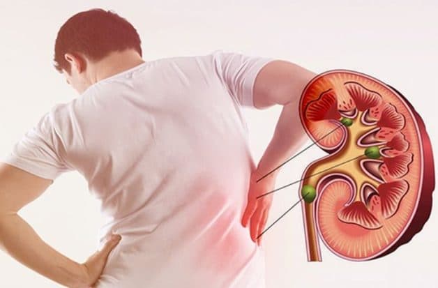 Hướng dẫn chẩn đoán và điều trị sỏi tiết niệu