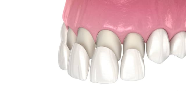 Dán sứ veneer: Phục hình thẩm mỹ vượt trội, bảo tồn răng thật tối đa