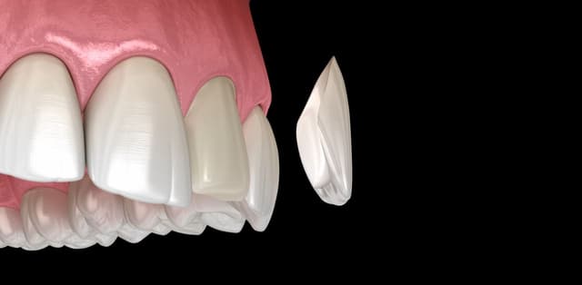 Thời gian hoàn thiện dán sứ veneer mất bao lâu?