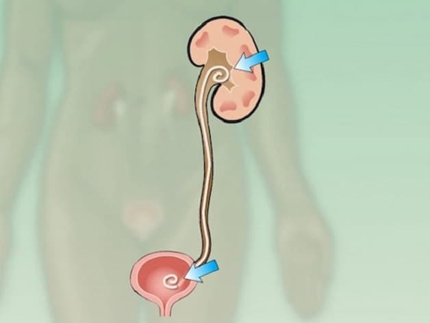Hẹp niệu quản có nguy hiểm không