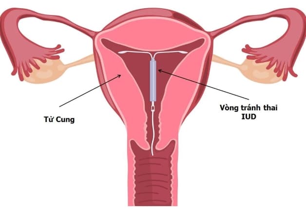 Nên lựa chọn các cơ sở y tế, bệnh viện uy tín để sử dụng biện pháp đặt vòng tránh thai