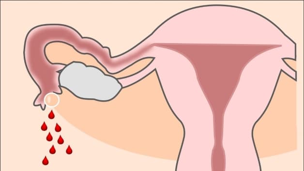 Dấu hiệu chửa ngoài tử cung - Chảy máu vùng âm đạo cũn là một trong những dấu hiệu cần phải chú ý bởi rất có thể đây là dấu hiệu của việc phụ nữ bị mang thai ngoài tử cung.