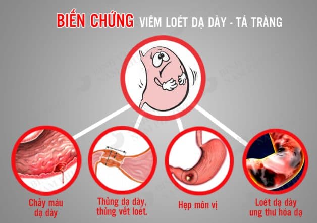 Biến chứng loét dạ dày