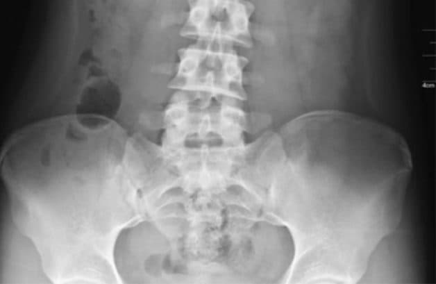 Chụp CT để chẩn đoán đau khớp cùng chậu