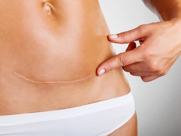 Mẹ cần hết sức cẩn thận và đảm bảo vết sẹo tử cung đã hoàn toàn bình phục trước khi quyết định đẻ mổ lần 3