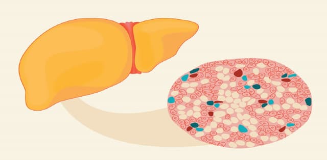 Gan nhiễm mỡ do rượu – những điều cần biết
