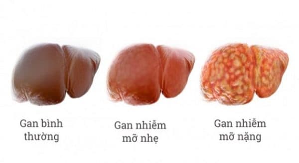 gan nhiễm mỡ có nguy hiểm không