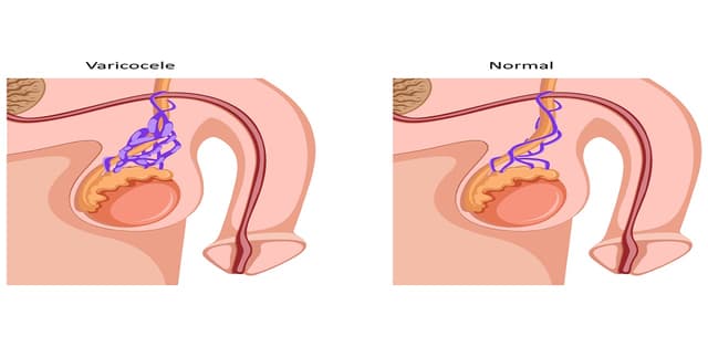 Thông tin về bệnh giãn tĩnh mạch thừng tinh là gì? 