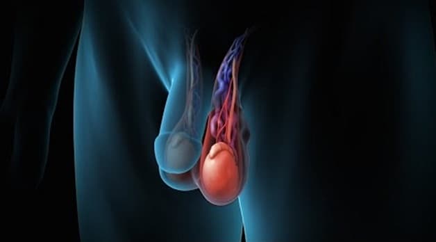 Giãn tĩnh mạch tinh hoàn gây đau, sưng