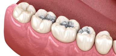 Thời gian hàn răng mất bao lâu thì xong?