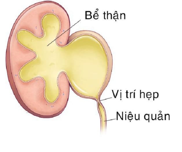 cách điều trị hẹp niệu quản